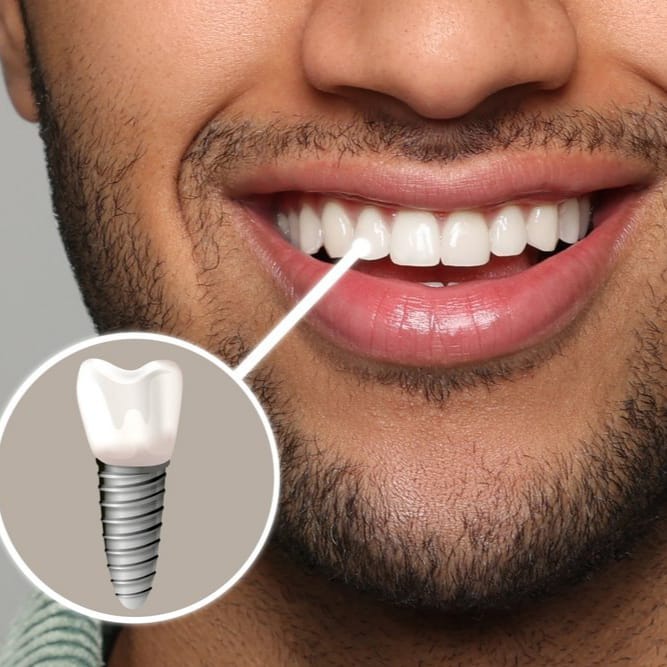 implant dentaire casablanca